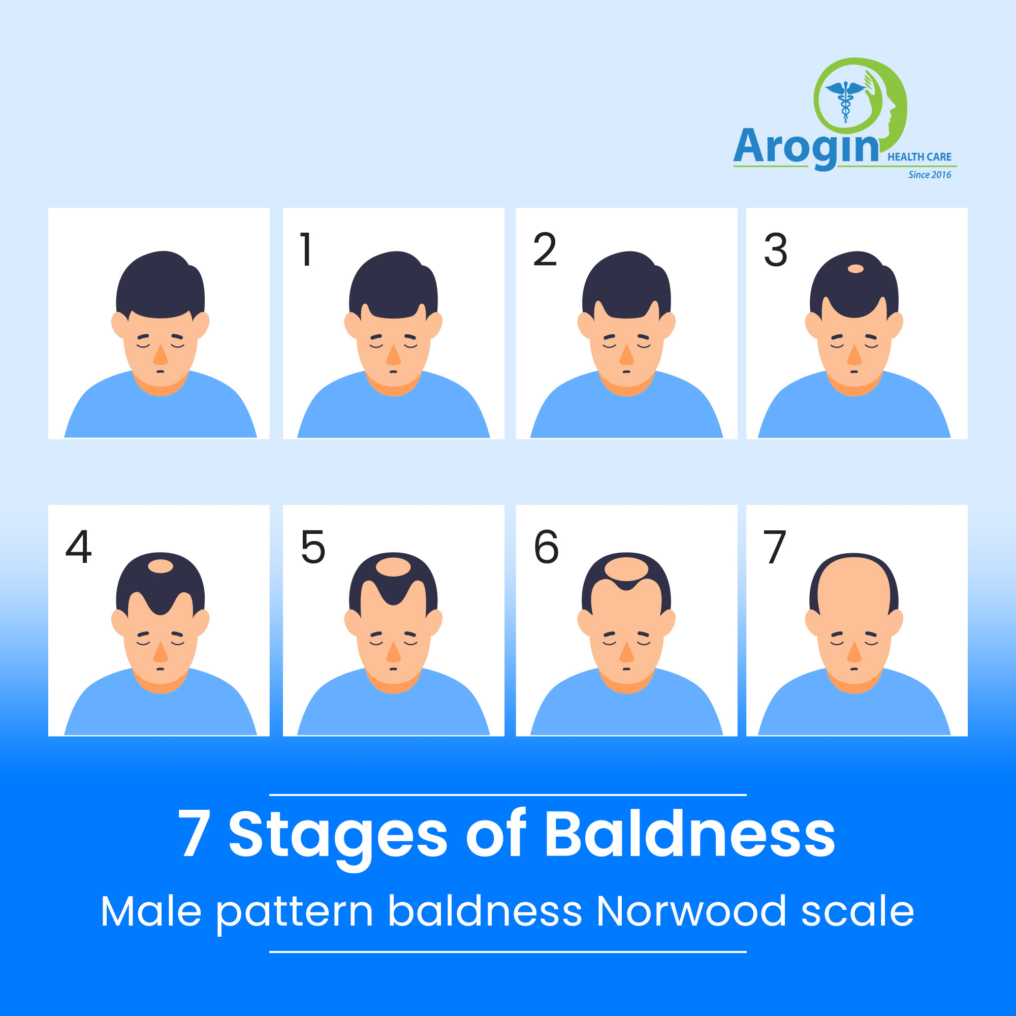 7 Stages of Baldness; Male pattern baldness Norwood scale